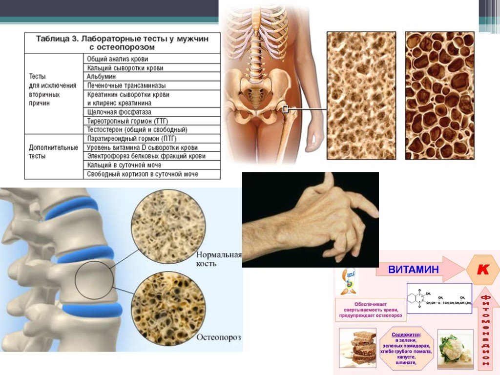 Анализ кости на остеопороз