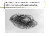Ветряная оспа, ветрянка(лат. Varicella)-острое вирусное заболевание с воздушно-капетельным путем передачи. Вызывается вирусом семейства Herpesviridae- варицелла-зостер (Varicella Zoster).