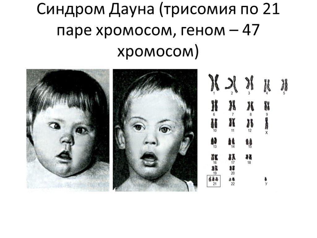 Синдром дауна лишняя хромосома. Синдром Дауна трисомия 21 хромосомы. Синдром Дауна трисомия по 21 хромосоме. Синдром Дауна (трисомия по 21 паре хромосом). Синдром Дауна трисомия 21.