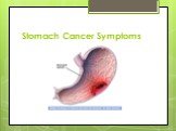 Stomach cancer symptoms Слайд: 7