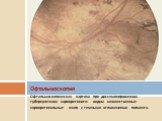 Офтальмоскопическая картина при диссеминированном туберкулезном хориоретините: видны множественные хориоретинальные очаги с темными отложениями пигмента.