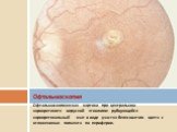 Офтальмоскопическая картина при центральном хориоретините вирусной этиологии: рубцующийся хориоретинальный очаг в виде участка белесоватого цвета с отложениями пигмента по периферии.