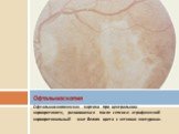 Офтальмоскопическая картина при центральном хориоретините, развившемся после сепсиса: атрофический хориоретинальный очаг белого цвета с четкими контурами.