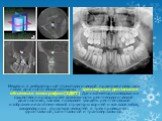 Недавно в амбулаторной стоматологической практике появилась новая диагностическая методика – трехмерная дентальная объемная томография (3ДКТ). Данный метод исследования существенно расширяет возможности рентгенологической диагностики, так как позволяет увидеть рентгеновское изображение анатомической