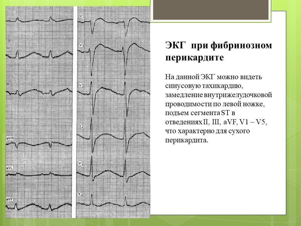 Перикардит экг картина