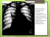 Рентгенограмма грудной клетки больного экссудативным перикардитом: тень сердца увеличена в поперечном размере, дуги плохо дифференцируются, форма сердца трапециевидная