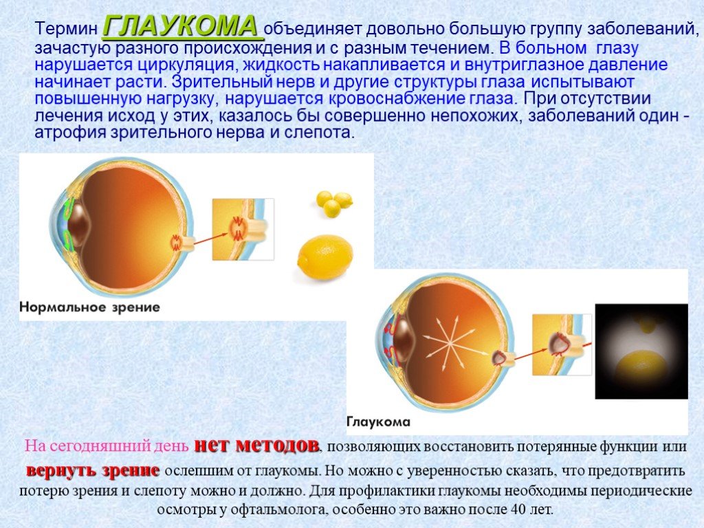 Можно вернуть зрение при глаукоме. Нарушения зрения глаукома. Презентация на тему глаукома. Профилактика глаукомы презентация. Профилактика слепоты от глаукомы.