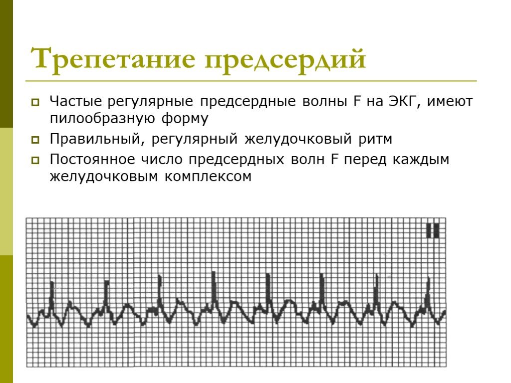 Волны при трепетании предсердий. Трепетание предсердий 1 к 1 на ЭКГ. Фибрилляция и трепетание предсердий. Трепетание предсердий на ЭКГ. Типичное трепетание предсердий ЭКГ.