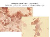 Иммуноцитохимическое исследование Суспензия из биоптата желудка (РЭА) Аденокарцинома