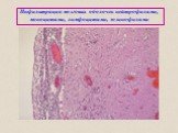 Инфильтрация мозговых оболочек нейтрофилами, моноцитами, лимфоцитами, эозинофилами