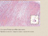Синдром Уотерхауса-Фридериксена Кровоизлияния и некроз в ткани надпочечников.