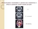 Компьютерная томография в диагностике невриномы в области развилки левой сонной артерии. КТ КТ с усилением 3D-rendering
