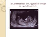 Ультразвуковое исследование плода (12 недель беременности)