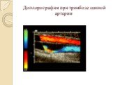 Доплерография при тромбозе сонной артерии