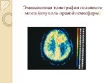 Эмиссионная томография головного мозга (опухоль правой гемисферы)