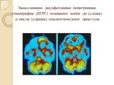 Эмиссионная двухфотонная позитронная томография (ПЭТ) головного мозга до (слева) и после (справа) эпилептического приступа