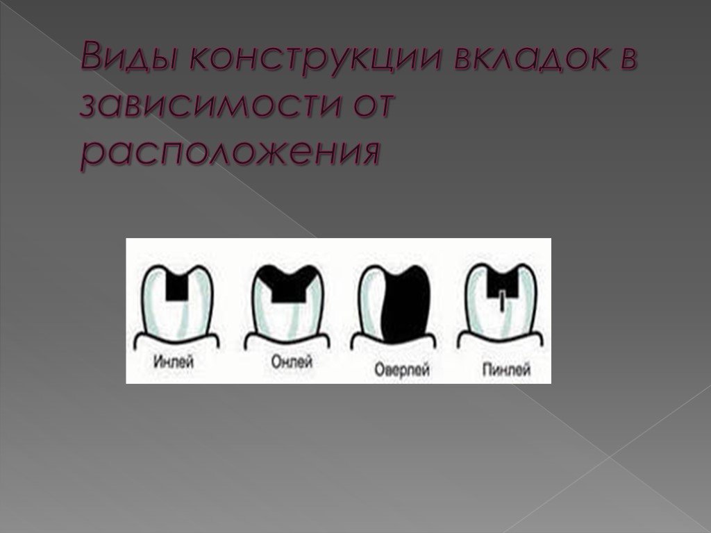 Виды вкладок. Виды конструкции вкладок в зависимости от расположения. Классификация вкладок. Виды конструкций вкладок. Классификация вкладок по конструкции.