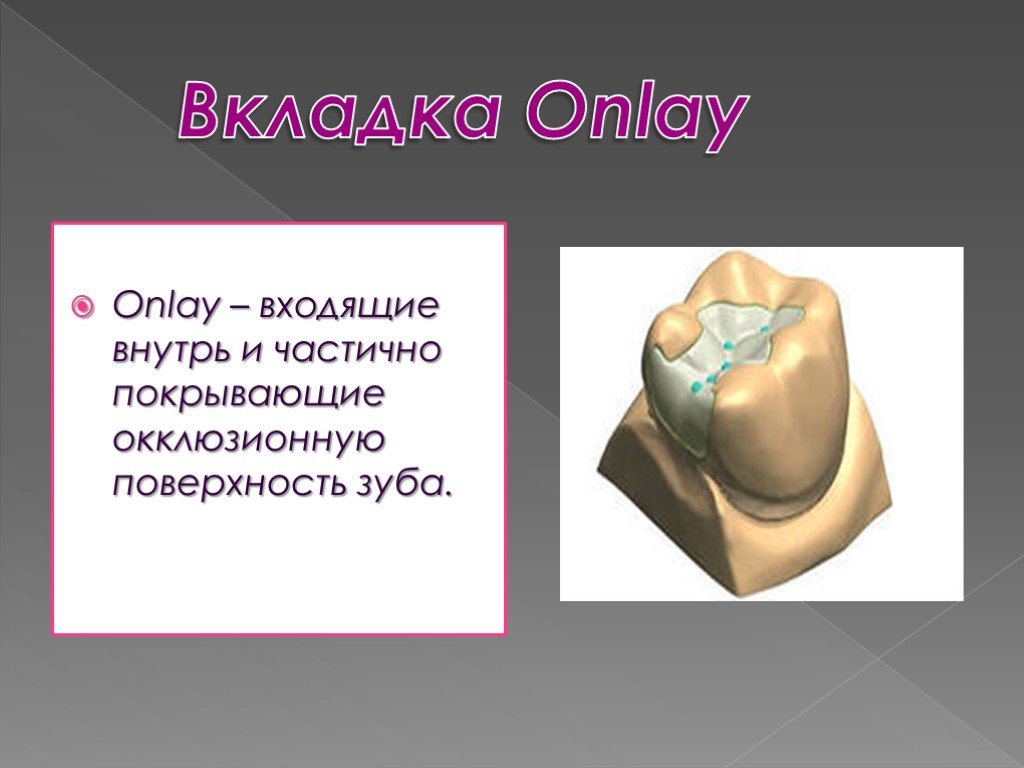 Появилась вкладка. Зубные вкладки презентация. Вкладка пинлей.