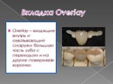 Вкладка Overlay. Overlay – входящие внутрь и охватывающий снаружи большую часть зуба с переходом и на другие поверхности коронки.