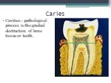 Caries. Cavities - pathological process is the gradual destruction of bone tissue or teeth.