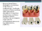 Reason dental bone - dystrophic or infection in the bone or nadkostnytsi, leading to necrosis of bone sections with subsequent absorption or rejection of dead mass and bone formation defect. Cavities can accompany some specific inflammatory processes (eg, tuberculosis, syphilis)