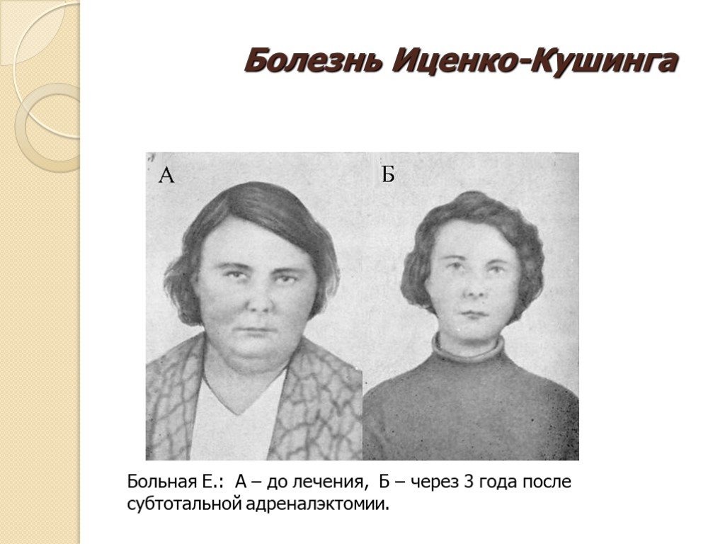 Через 3 года после. Аденома гипофиза Иценко Кушинга. Болезнь Иценко-Кушинга. Болезнь Иценко Кушинга симптомы. Симптомокомплекс Иценко Кушинга.