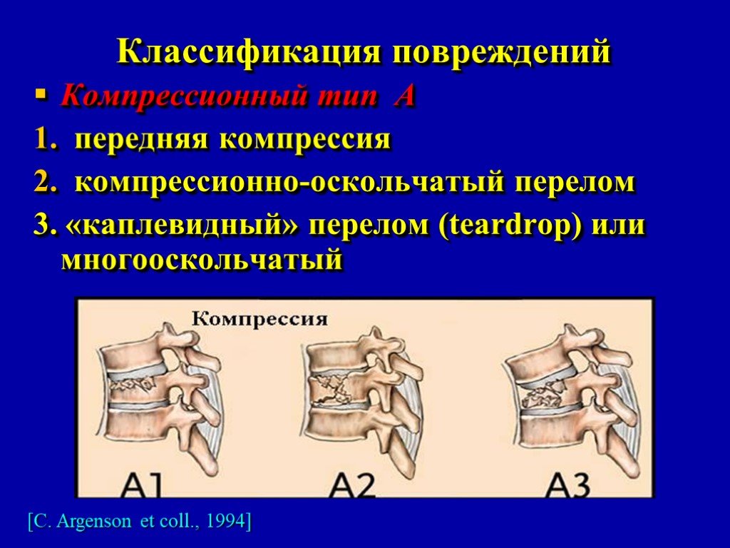 Компрессионный перелом позвонка классификация. Классификация компрессионных переломов позвонков. Классификация переломов позвонков по АО. Компрессионный перелом позвоночника а1.