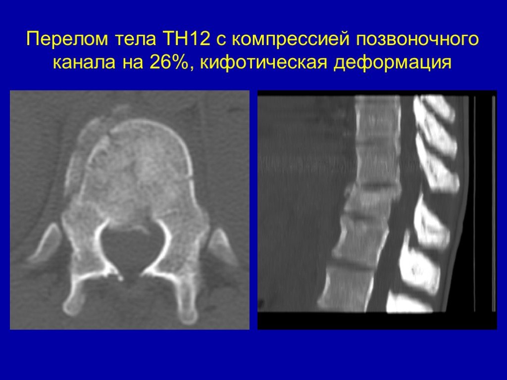 Перелом туловища. Перелом тела th9 позвонка. Вертикальный перелом тела позвонка. Кифотическая деформация.