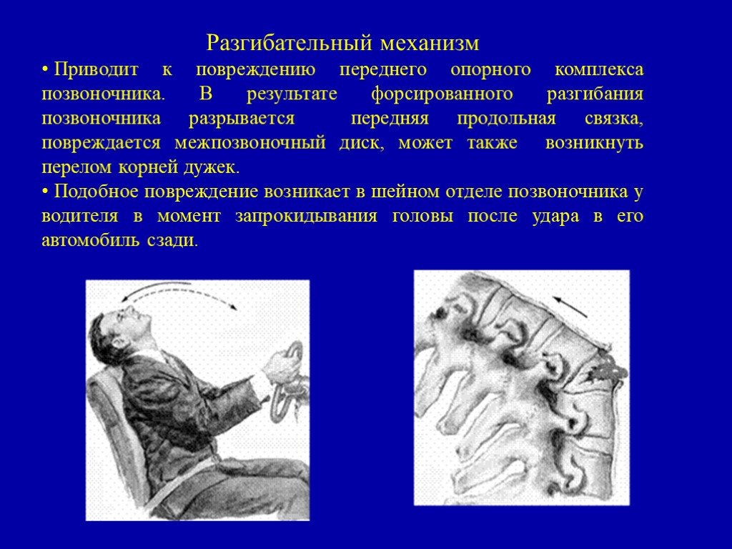 Также возникает. Разгибательный механизм травмы. Травмы позвоночника презентация. Разгибательное повреждение позвоночника. Причины травм позвоночника.