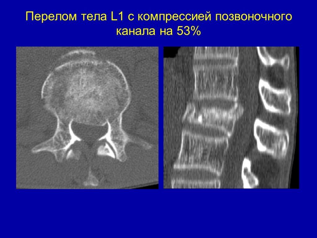 Компрессионный перелом позвоночника l1. Перелом дужки тела позвонка. Перелом тела l1 позвонка.