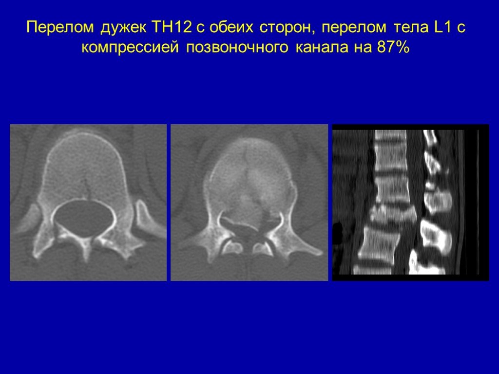 С обеих сторон. Перелом дужки позвонка. Перелом дужек позвонков с5. Перелом дужки l5. Перелом левой дужки позвонка l4.