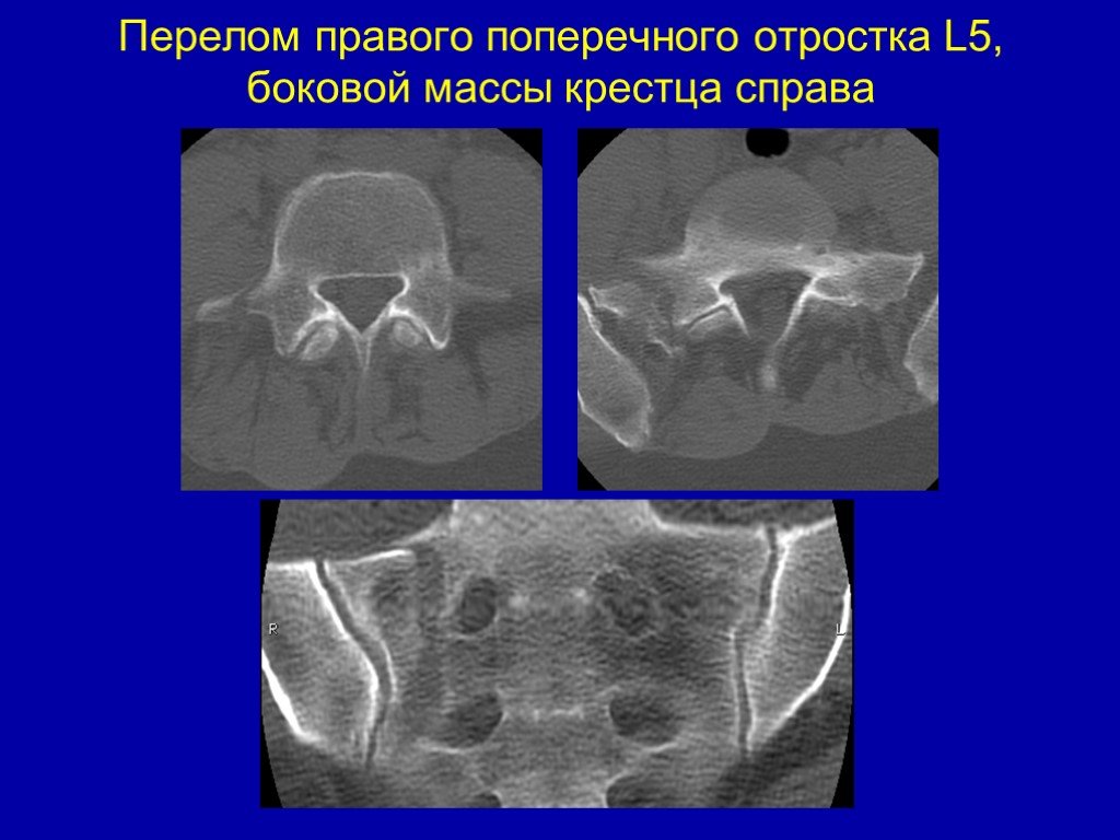 Перелом крестца. Перелом боковых масс крестца кт. Перелом 5 крестцового позвонка рентген. Перелом поперечного отростка l5. Перелом латеральной части крестца.