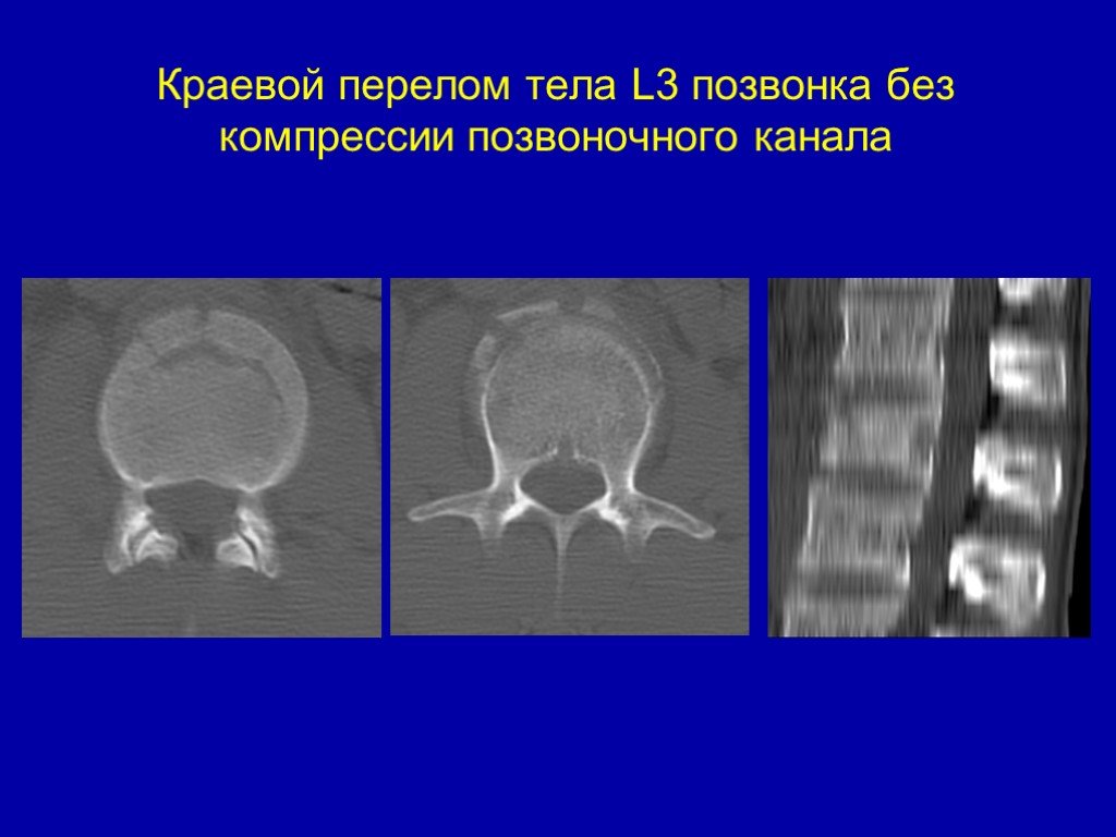 Перелом тела позвонка. Краевой перелом позвонка позвоночника. Краевой перелом тела l2 позвонка. Краевой перелом позвоночника l3.