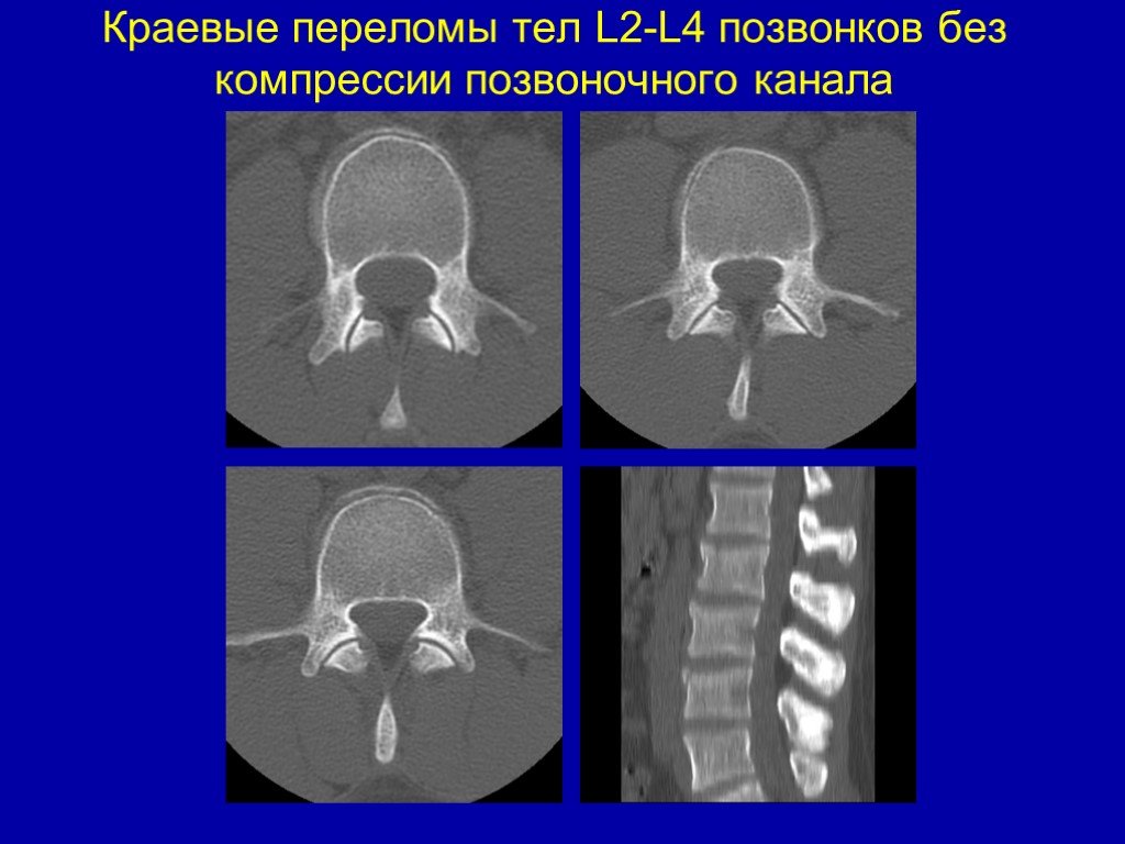 Перелом туловища. Перелом тела l2 позвонка. Краевой перелом тела l2 позвонка. Краевой перелом тела позвонка на кт. Краевой перелом позвонка поясничного отдела.