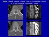 Краевой перелом передних отделов тела ТН6 со снижением высоты на 1/3 без компрессии позвоночного канала