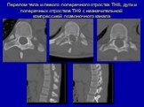 Перелом тела и левого поперечного отростка ТН8, дуги и поперечных отростков ТН9 с незначительной компрессией позвоночного канала