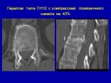 Перелом тела ТН12 с компрессией позвоночного канала на 43%