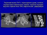 Переломо-вывих ТН7 с переходом на дужки, полным перекрытием позвоночного канала, перелом передне-верхних отделов тела ТН8, кифотическая деформация