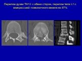 Перелом дужек ТН12 с обеих сторон, перелом тела L1 c компрессией позвоночного канала на 87%