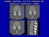 Краевые переломы тел L2-L4 позвонков без компрессии позвоночного канала