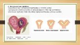 2. Механические факторы амниотические сращения (перегородки в полости матки) чрезмерное давление матки на развивающийся плод при маловодии давление органов плода опухолью (фиброматозными узлами в матке). Схематическое изображение плода в матке при межмышечном миоматозном узле