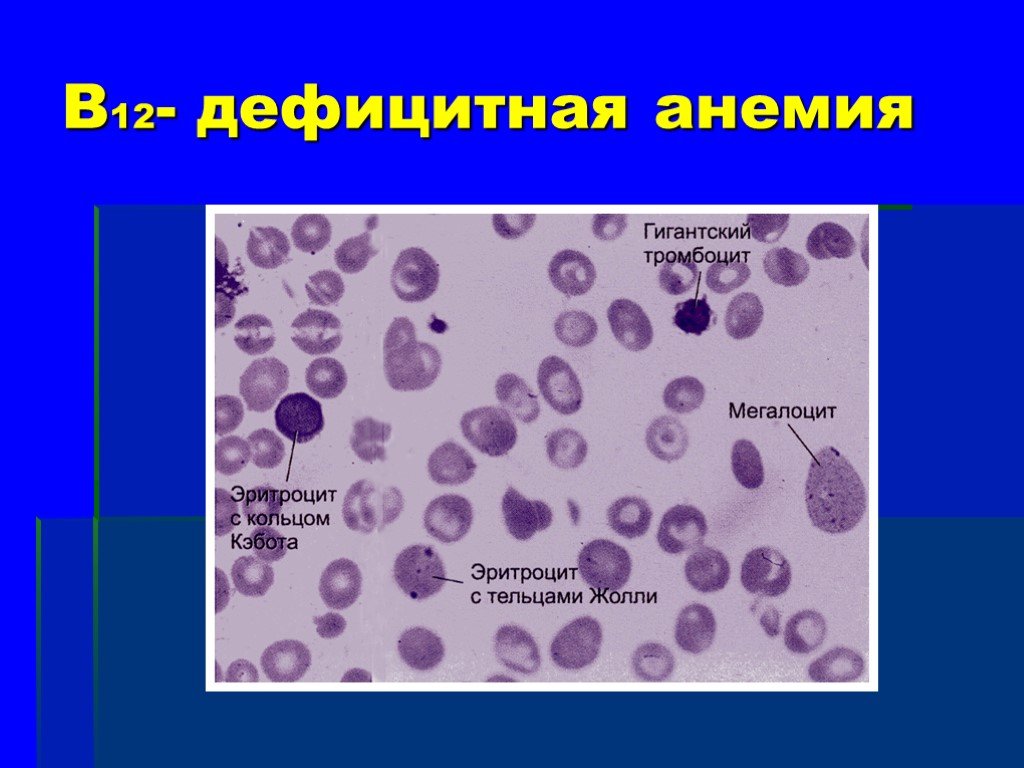 Изменение клеток крови. Клетки при б12 дефицитной анемии. В12 дефицитная анемия микропрепарат. Б12 дефицитная анемия мазок крови. Эритроциты при в 12 анемии.