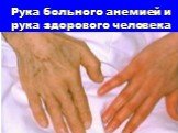 Рука больного анемией и рука здорового человека