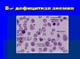 В12- дефицитная анемия