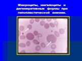 Макроциты, мегалоциты и дегенеративные формы при гипопластической анемии.