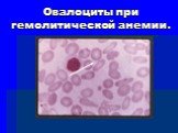Овалоциты при гемолитической анемии.
