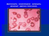 Дрепаноциты, мишеневидные эритроциты, дакриоцит (дрепано-талассемия).