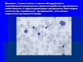 Большая -талассемия: в мазке обнаруживают гипохромный микроцитоз, мишенеподобные эритроциты, пойкилоциты и ядросодержащие эритроциты. Некоторое количество нормальных эритроцитов – это клетки перелитой донорской крови.