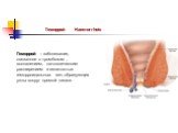 Геморрой Haemorrhois. Геморрой – заболевание, связанное с тромбозом , воспалением, патологическим расширением и извитостью геморроидальных вен, образующих узлы вокруг прямой кишки.