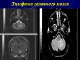 Лимфома головного мозга
